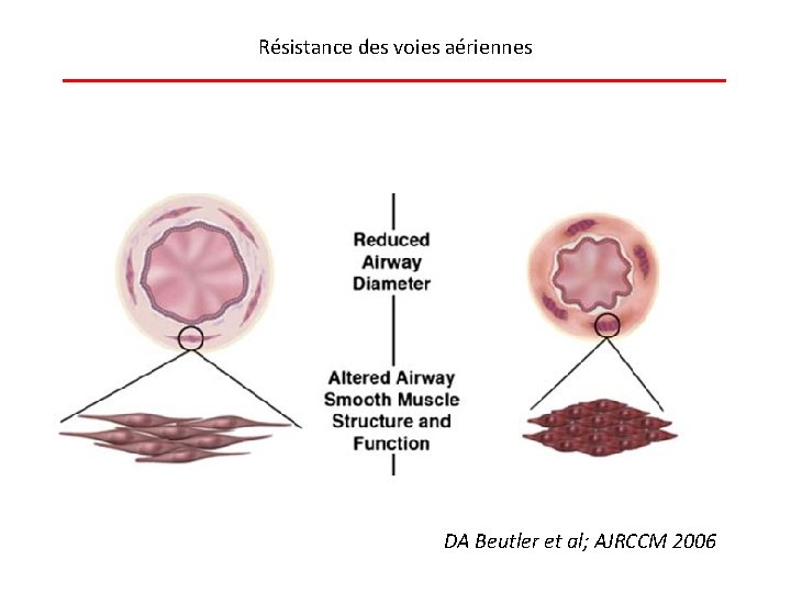 Résistance des voies aériennes DA Beutler et al; AJRCCM 2006 