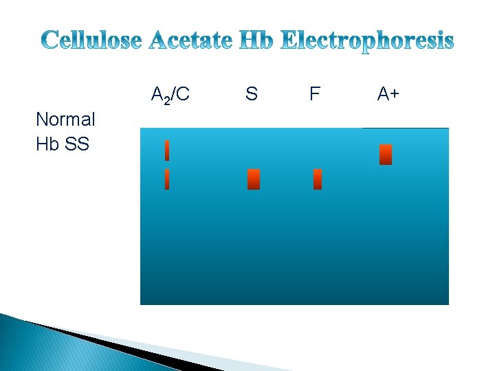 A 2/C Normal Hb SS S F A+ 