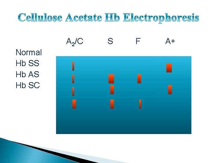 A 2/C Normal Hb SS Hb AS Hb SC S F A+ 