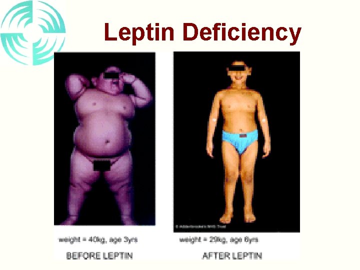 Leptin Deficiency 