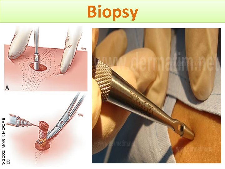Biopsy 