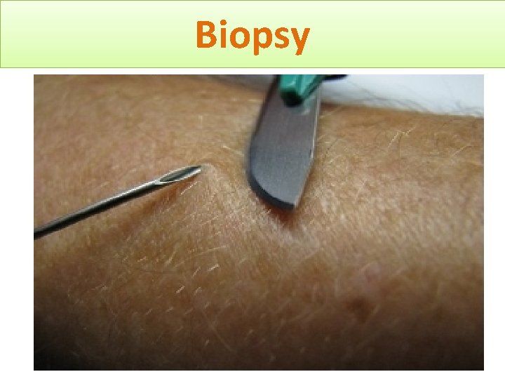 Biopsy 