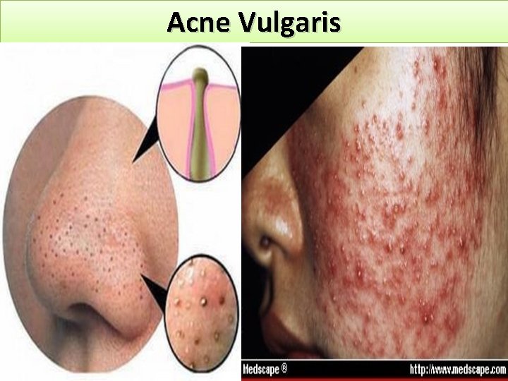 Acne Vulgaris 