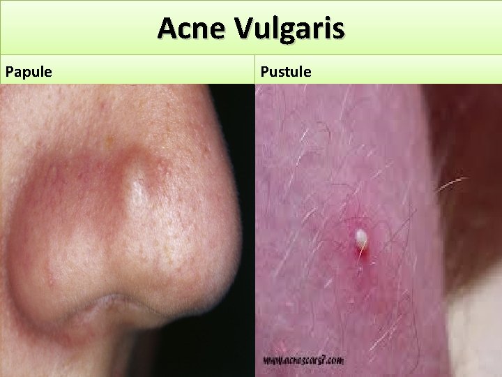 Acne Vulgaris Papule Pustule 