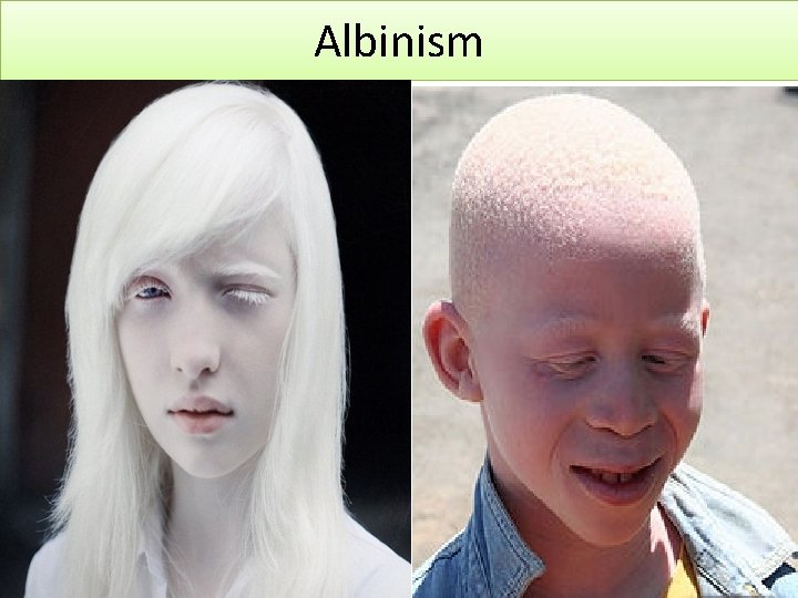 Albinism 