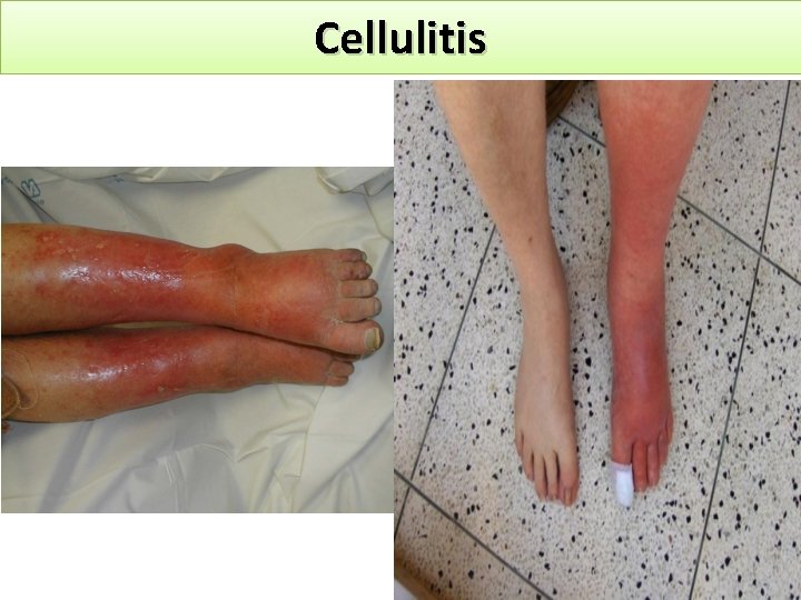 Cellulitis 