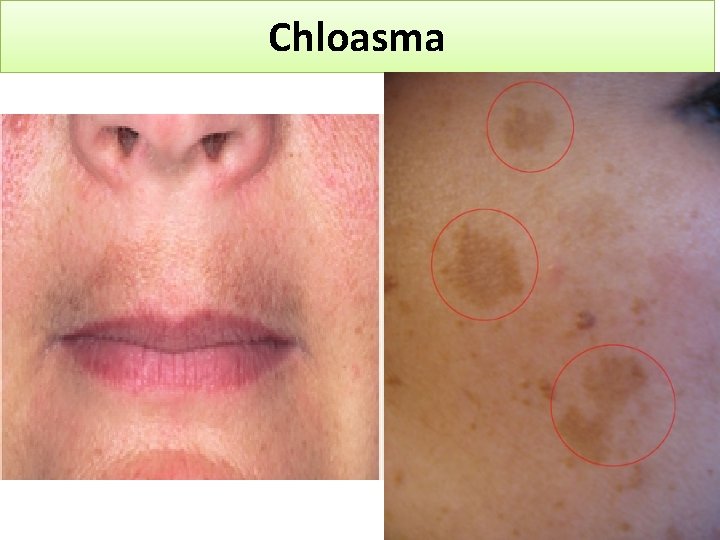 Chloasma 