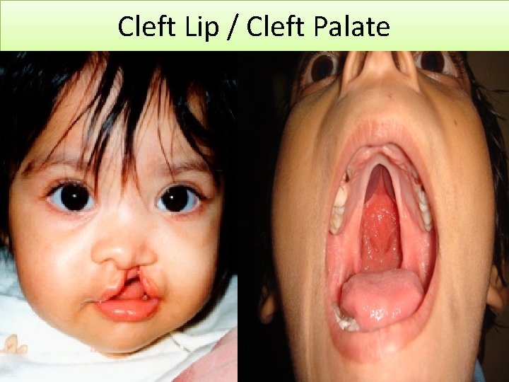 Cleft Lip / Cleft Palate 