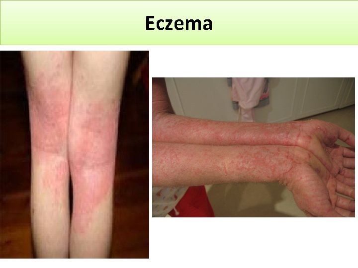 Eczema 