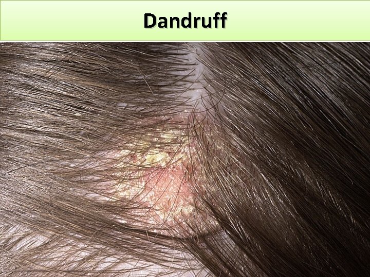 Dandruff 