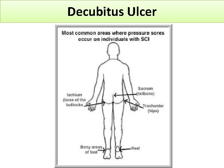 Decubitus Ulcer 