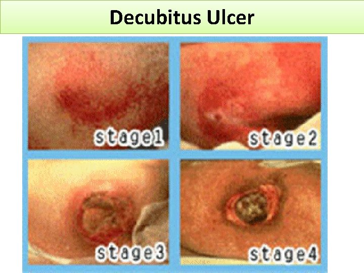 Decubitus Ulcer 