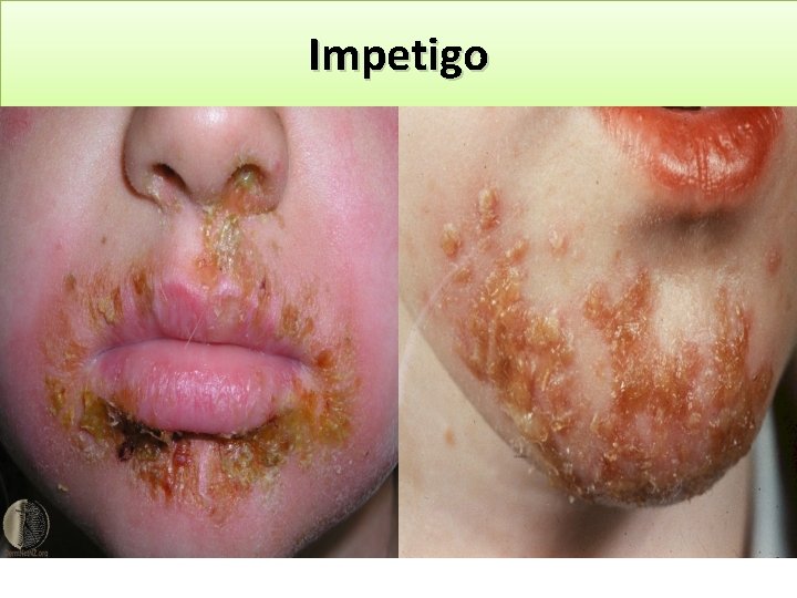 Impetigo 