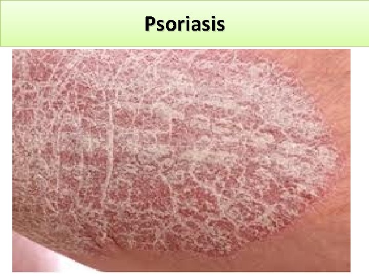 Psoriasis 