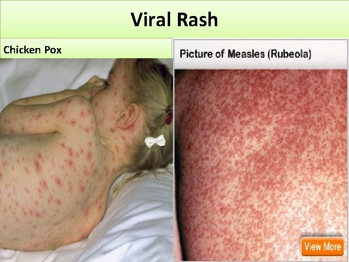 Viral Rash Chicken Pox 