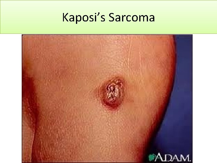 Kaposi’s Sarcoma 