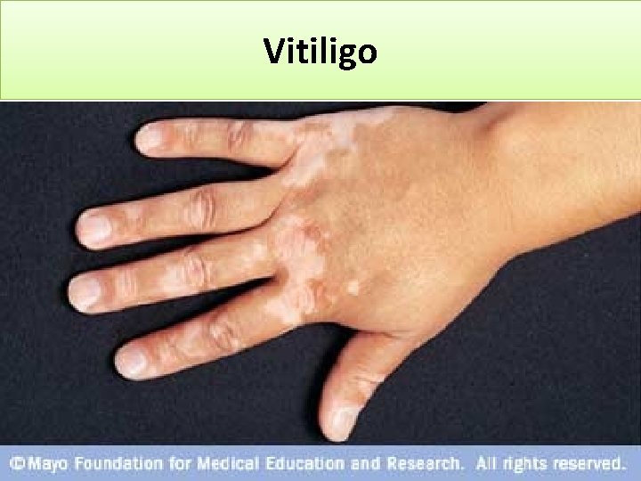 Vitiligo 