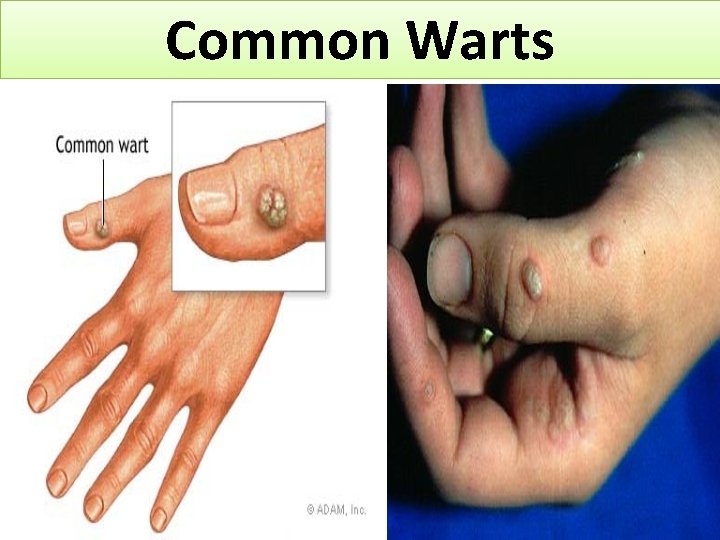 Common Warts 