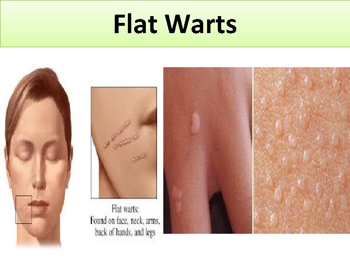 Flat Warts 