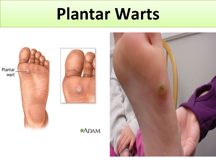 Plantar Warts 