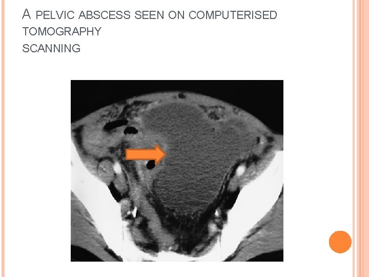 A PELVIC ABSCESS SEEN ON COMPUTERISED TOMOGRAPHY SCANNING 