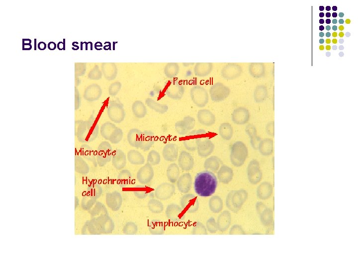 Blood smear 