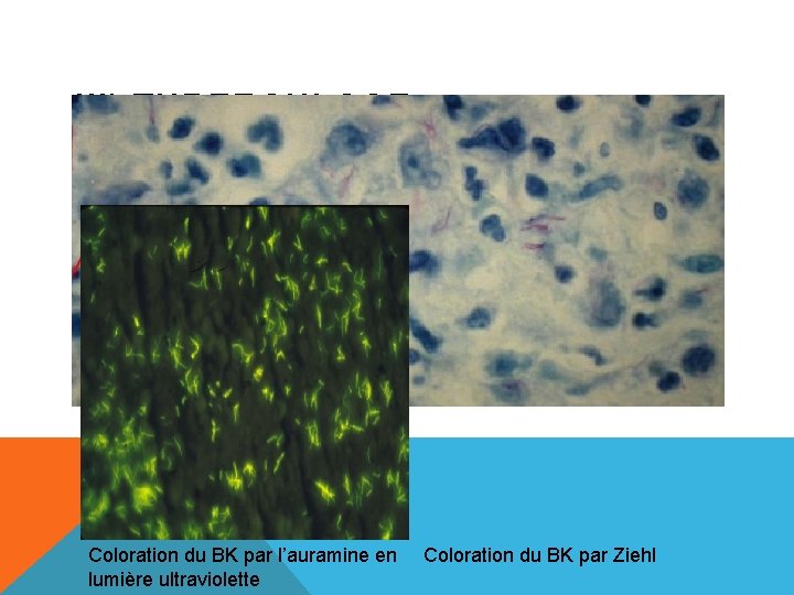 III) TUBERCULOSE Coloration du BK par l’auramine en lumière ultraviolette Coloration du BK par