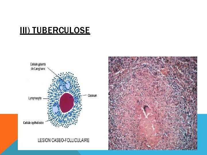 III) TUBERCULOSE 