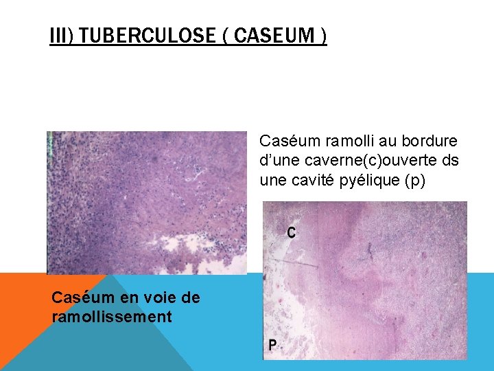 III) TUBERCULOSE ( CASEUM ) Caséum ramolli au bordure d’une caverne(c)ouverte ds une cavité
