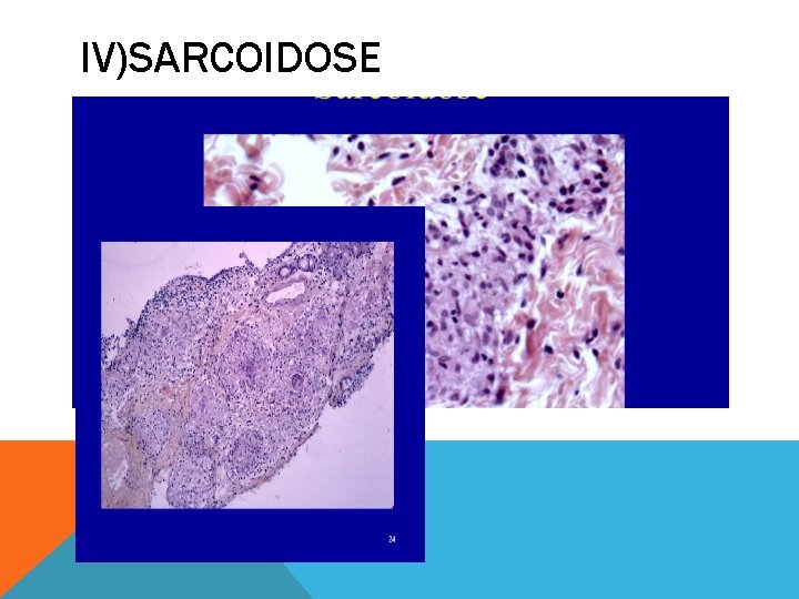 IV)SARCOIDOSE 