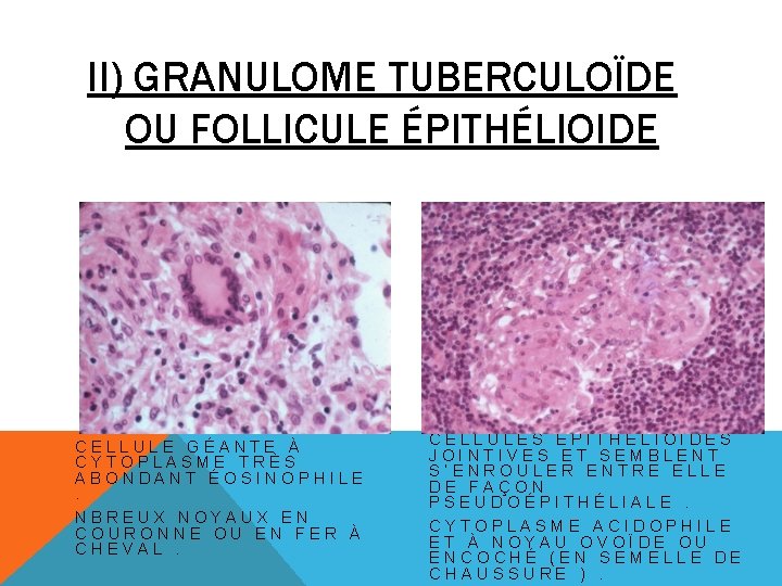 II) GRANULOME TUBERCULOÏDE OU FOLLICULE ÉPITHÉLIOIDE CELLULE GÉANTE À CYTOPLASME TRÈS ABONDANT ÉOSINOPHILE. NBREUX