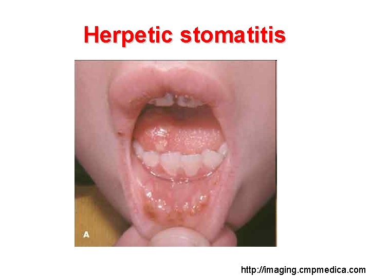 Herpetic stomatitis http: //imaging. cmpmedica. com 