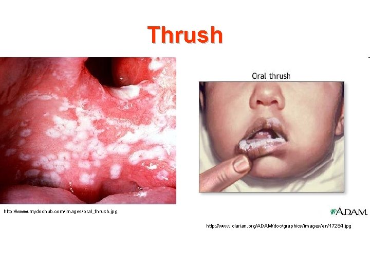 Thrush http: //www. mydochub. com/images/oral_thrush. jpg http: //www. clarian. org/ADAM/doc/graphics/images/en/17284. jpg 