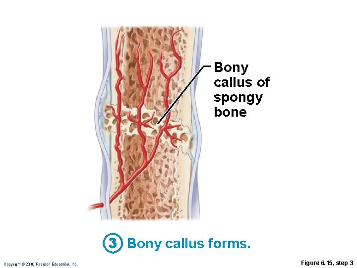 Bony callus of spongy bone 3 Bony callus forms. Copyright © 2010 Pearson Education,