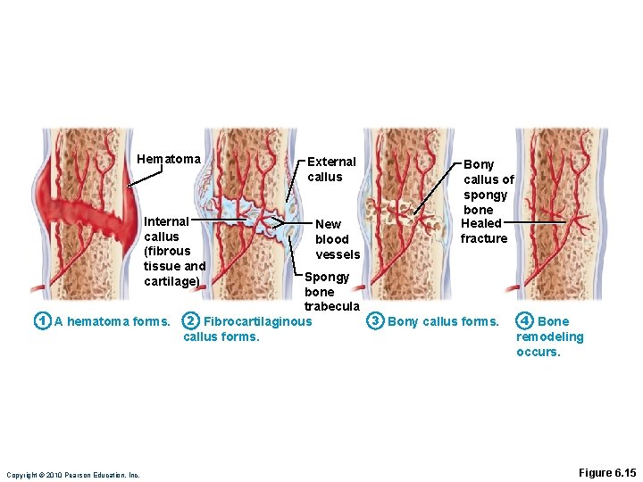 Hematoma Internal callus (fibrous tissue and cartilage) External callus New blood vessels Bony callus