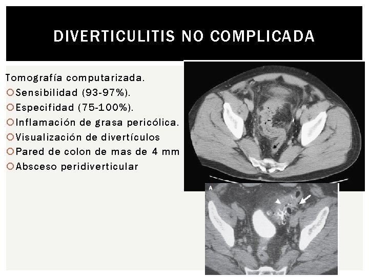 DIVERTICULITIS NO COMPLICADA Tomografía computarizada. Sensibilidad (93 -97%). Especifidad (75 -100%). Inflamación de grasa