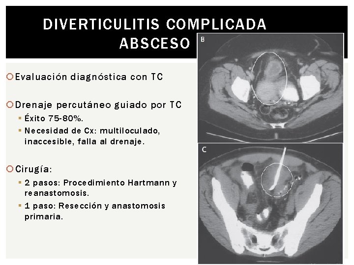 DIVERTICULITIS COMPLICADA ABSCESO Evaluación diagnóstica con TC Drenaje percutáneo guiado por TC § Éxito