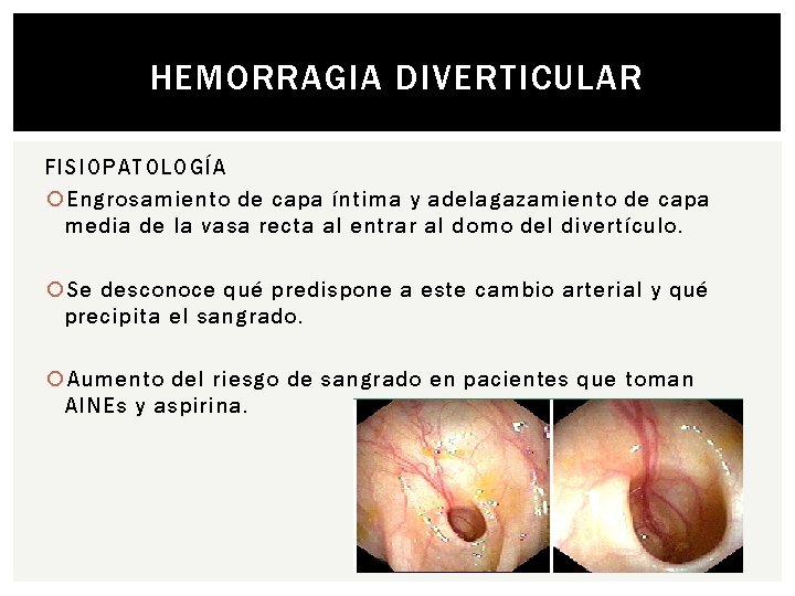 HEMORRAGIA DIVERTICULAR FISIOPATOLOGÍA Engrosamiento de capa íntima y adelagazamiento de capa media de la
