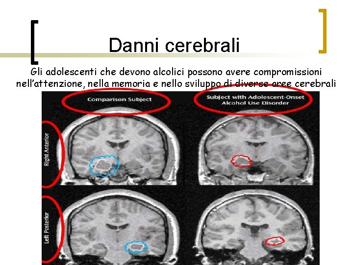 Danni cerebrali Gli adolescenti che devono alcolici possono avere compromissioni nell’attenzione, nella memoria e