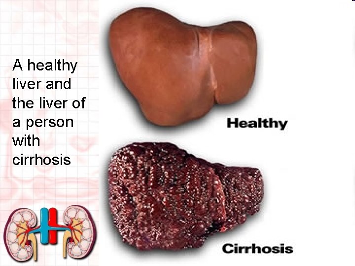 A healthy liver and the liver of a person with cirrhosis 