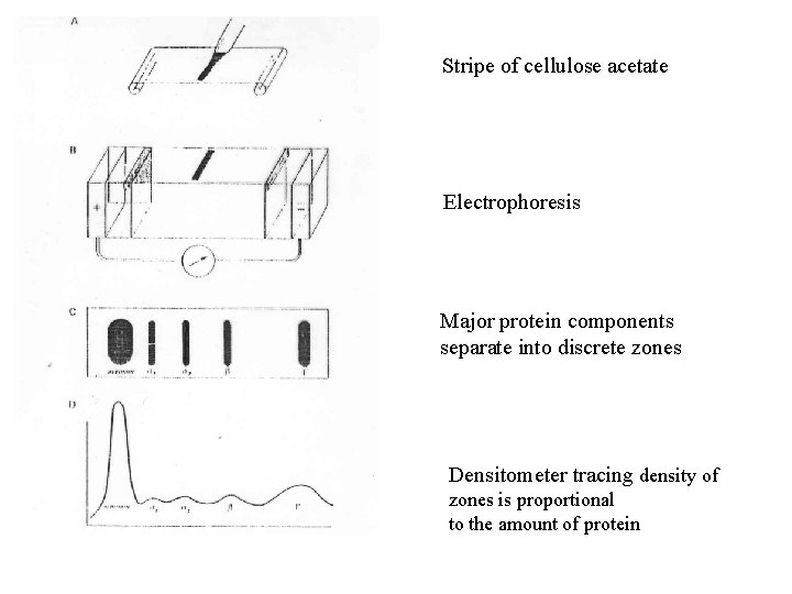 Stripe of cellulose acetate Electrophoresis Major protein components separate into discrete zones Densitometer tracing