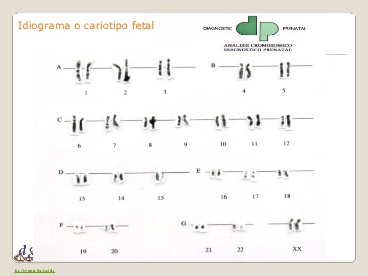 Idiograma o cariotipo fetal Dr. Antonio Barbadilla 