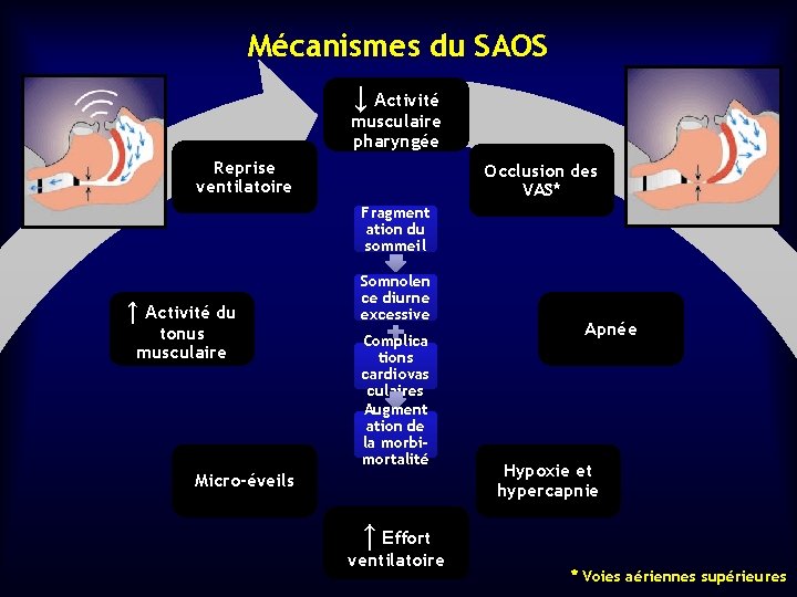 Mécanismes du SAOS ↓ Activité musculaire pharyngée Reprise ventilatoire Occlusion des VAS* Fragment ation