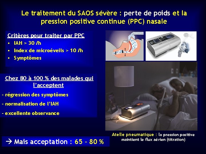 Le traitement du SAOS sévère : perte de poids et la pression positive continue