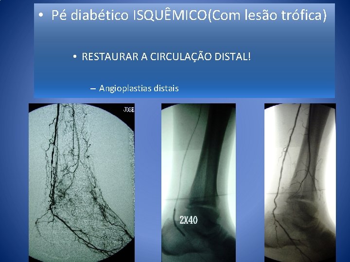  • Pé diabético ISQUÊMICO(Com lesão trófica) • RESTAURAR A CIRCULAÇÃO DISTAL! – Angioplastias