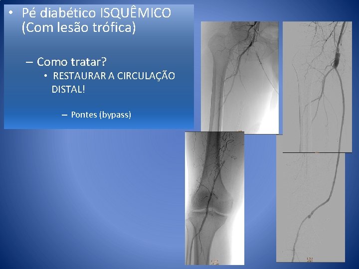  • Pé diabético ISQUÊMICO (Com lesão trófica) – Como tratar? • RESTAURAR A