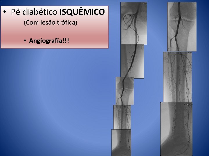  • Pé diabético ISQUÊMICO (Com lesão trófica) • Angiografia!!! 