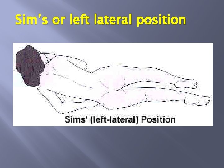 Sim’s or left lateral position 
