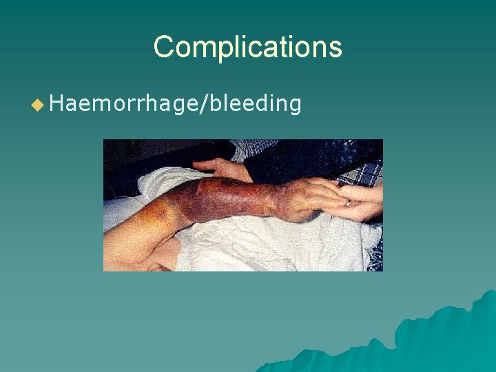 Complications u Haemorrhage/bleeding 