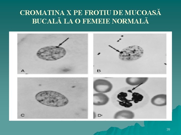 CROMATINA X PE FROTIU DE MUCOASĂ BUCALĂ LA O FEMEIE NORMALĂ 39 